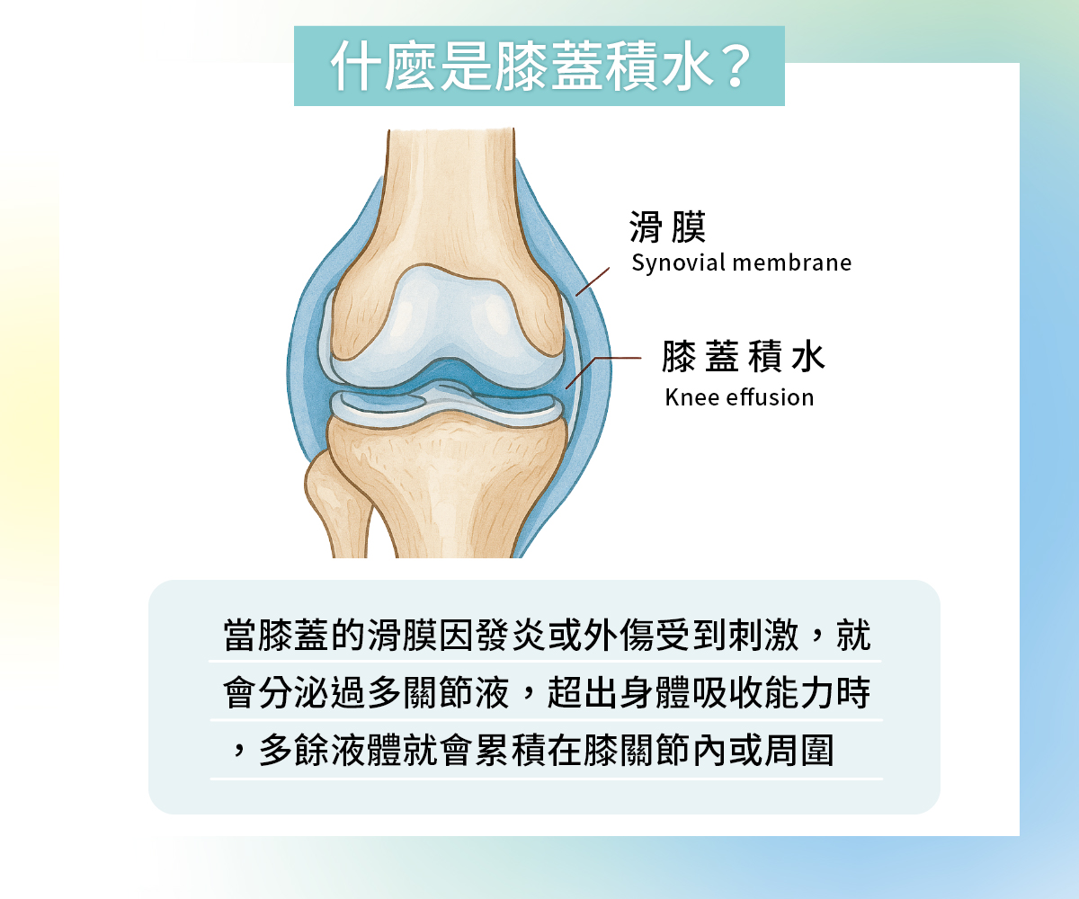 什麼是膝蓋積水